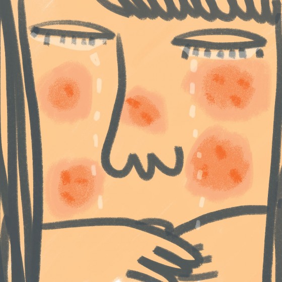Acne by Amy Ng